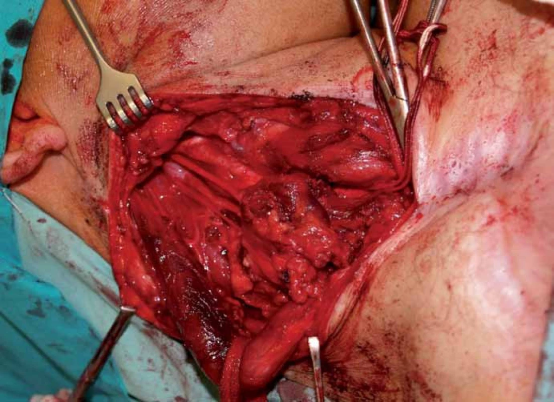 Operační pole před výkonem.
1 – n. hypoglossus, 2 – n. vagus, 3 – a. carotis interna, 4 – tumor, 5 – m. sternocleidomastoideus,
6 – větve cervikálního plexu.