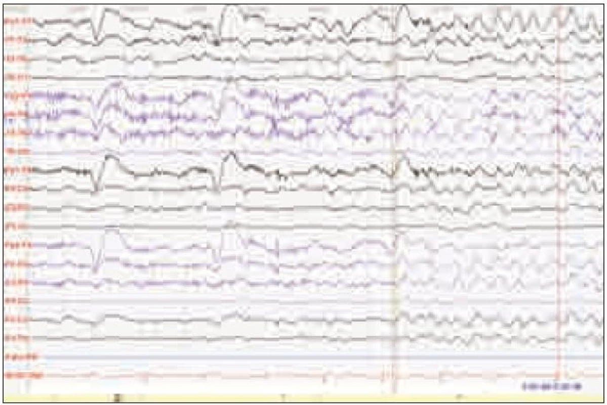 Na iktálním EEG (počátek záchvatu) je patrný rozvoj rytmické delta aktivity oboustranně frontotemporálně s jasnou pravostrannou převahou.