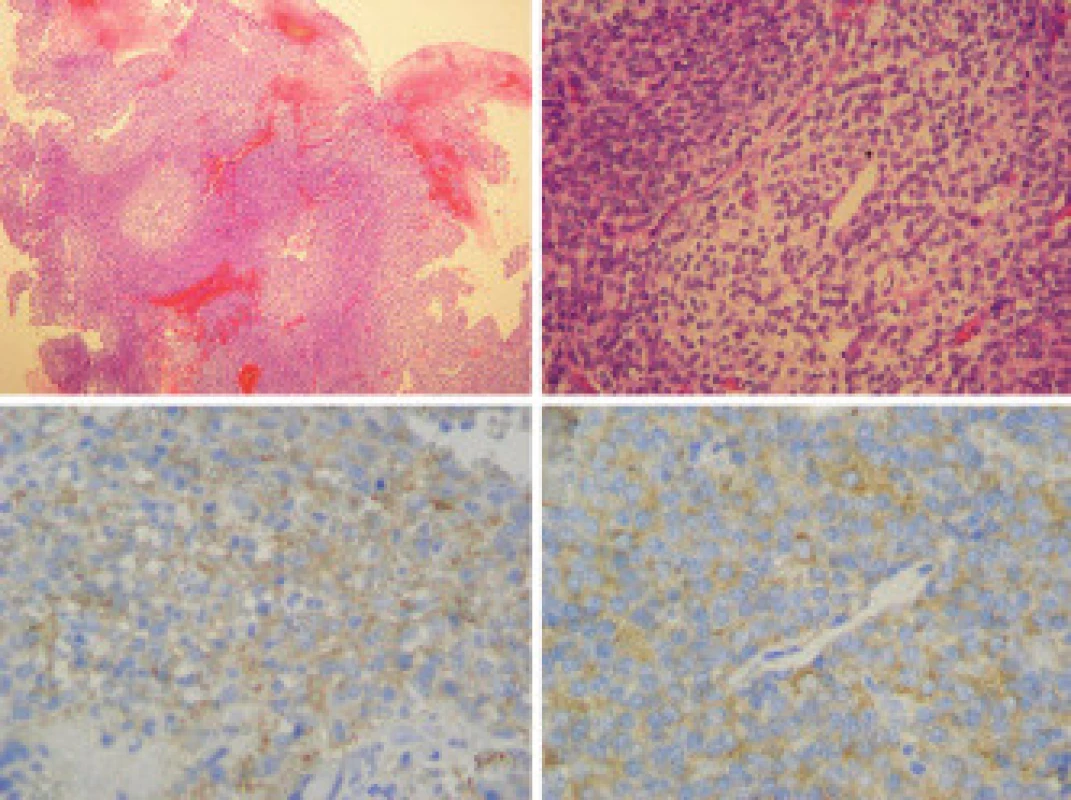 Histologické a imunohistochemické vyšetření. Barvení na hematoxillin-eozin ukazuje uniformní cévnatý tumor skládající se z ostrůvků neuropilu a buněčné komponenty podobné buňkám oligodendrogliomu (a, b). Pozitivní imunohistochemické barvení na neuron-specifickou enolázu (c) a synaptofyzin (d) potvrzuje diagnózu centrálního neurocytomu.