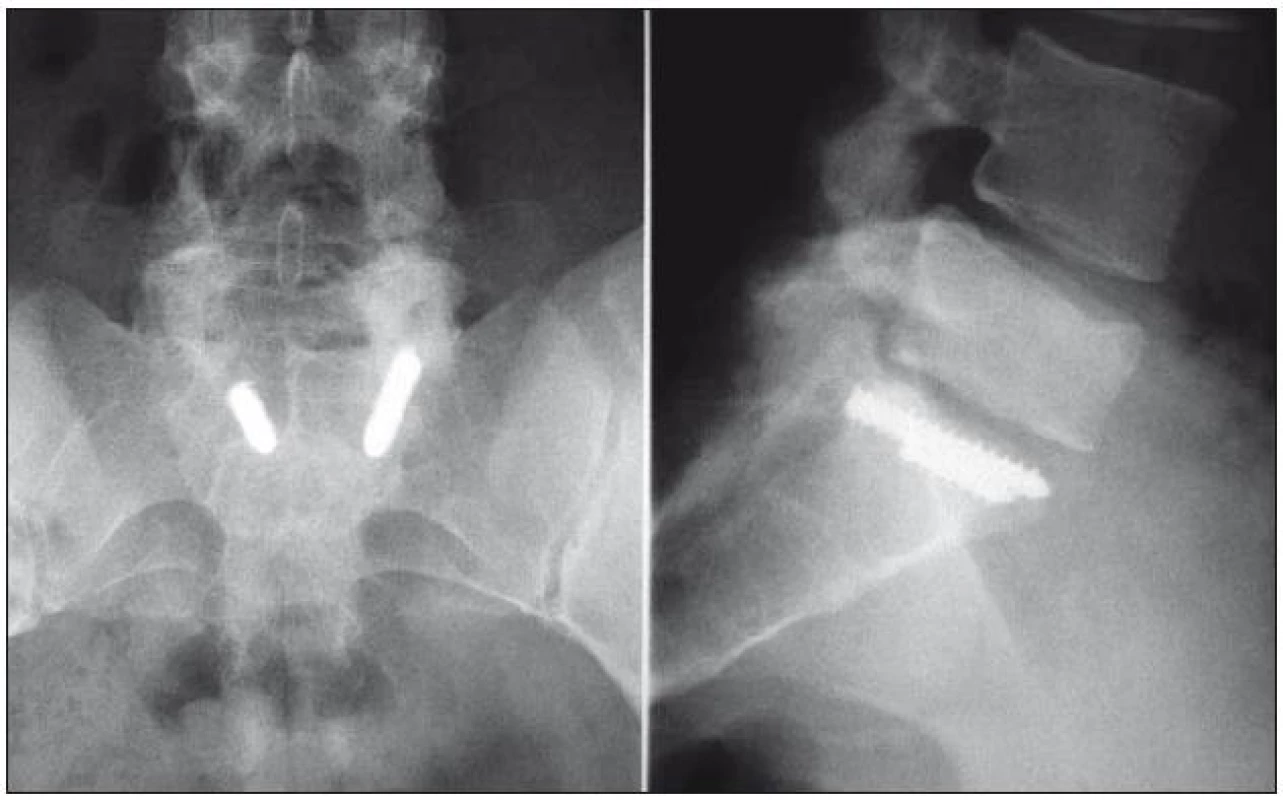 Typická komplikace po stabilizaci zlomeniny L5 – zalomení šroubů v těle S1.
