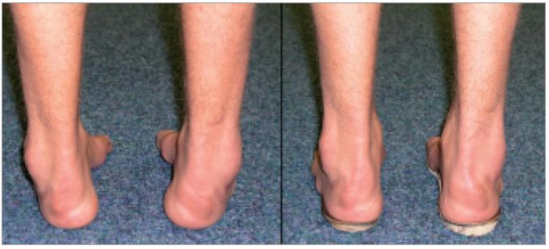 Ortopedické vložky zhotovené dle aktuálních individuálních měrných podkladů mohou pozitivně ovlivnit postavení nohy.