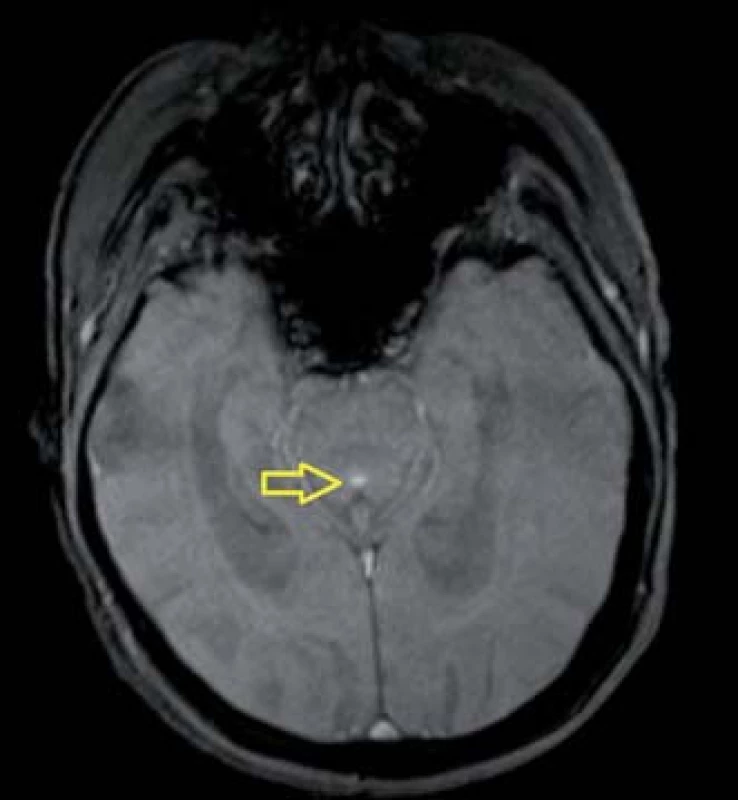 PC-MR u pacienta s NPH. Žlutá šipka ukazuje na signál toku likvoru v aqueductus mesencephali.