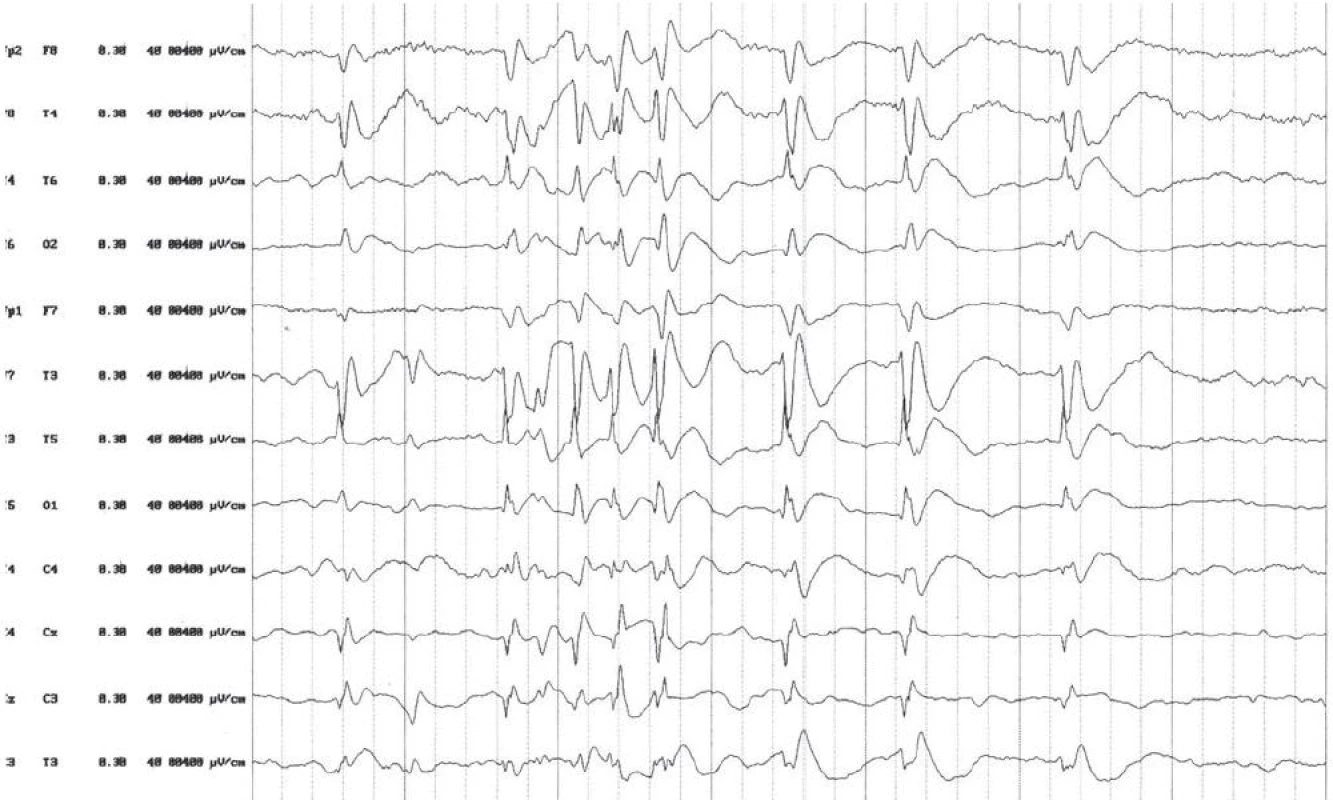 EEG nález pred nasadením liečby ACTH. V spánkovom zápise sú prítomné dve nezávislé ohniská v temporálnych zvodoch obojstranne s generalizáciou.