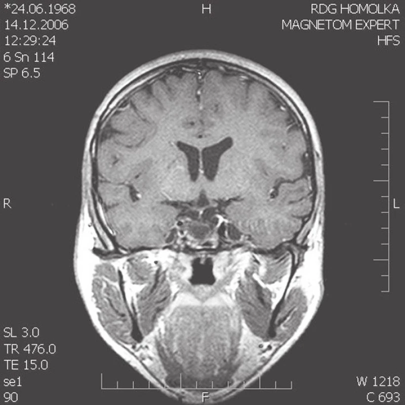 (a–c). MRI snímky. Na T1 váženém postkontrastním koronárním skenu je reziduální intraselární kraniofaryngeom po parciální operaci a reoperaci subfrontálním přístupem a brachyterapii yttriem90 cystické části tumoru u 21letého muže (obr. 1a). Na MRI kontrole 7 (obr. 1b) a 10 let (obr. 1c) po ozáření gama nožem zůstává postupně se zmenšující intraselární cystické reziduum kraniofaryngeomu. Pacient je v dobré celkové kondici, panhypopituitarizmus je kompenzovaný endokrinologickou medikací, kontrolní oční vyšetření neprokazuje žádné zhoršení perimetru, porucha vizu je zlepšena brýlovou korekcí, postižení n. abducens se upravuje. Dosavadní poradiační průběh je příznivý.