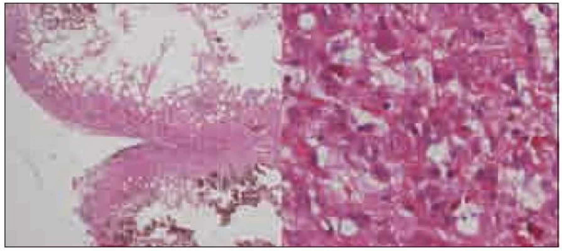 Histologický preparát, vlevo zachovalá rozšířená folia mozečku (HE, 20krát), vpravo dysplastické gangliové buňky kory mozečku (HE, 200krát).