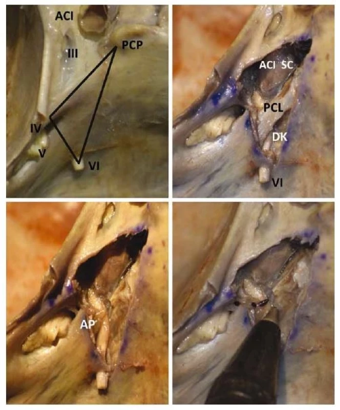Anatomická sekce inferomediálního trojúhelníku baze lební. Na posledním záběru porovnání apexu pyramidy s hrotem propisky, apex pro názornost označen černě. III-VI – hlavové nervy; ACI – arteria carotis interna; AP – apex pyramidy; DK – Dorellův kanál; PCL – petroclinoidní ligamentum – Grüberovo; PCP – processus clinoideus posterior, SC – sinus cavernosus<br>Fig. 1. The anatomical study of the inferomedial triangle of the cranial base. On the last picture is a comparison of the petrous apex with the pen tip, where the apex is marked in black for clarity. III-VI – cranial nerves; ACI – arteria carotis interna; AP – petrous apex; DK – Dorello´s canal; PCL – petroclinoid ligament – Gruber´s ligament; PCP – posterior clinoid proces; SC – cavernous sinus