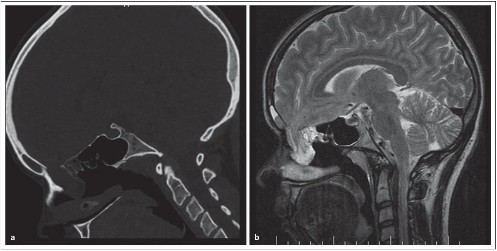 Nazofaryngeální encefalokéla, typ transetmoidální v obraze.
Obr. 1a) CT, obr. 1b) MR.