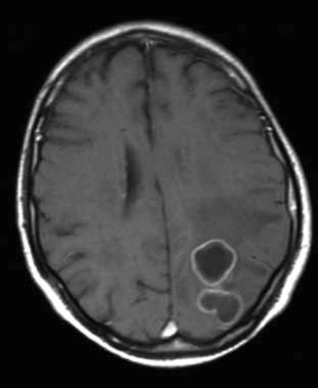 Vstupní MR vyšetření mozku 11. 2. 2009 (axiální T1 vážený obraz po podání gadoliniové kontrastní látky).