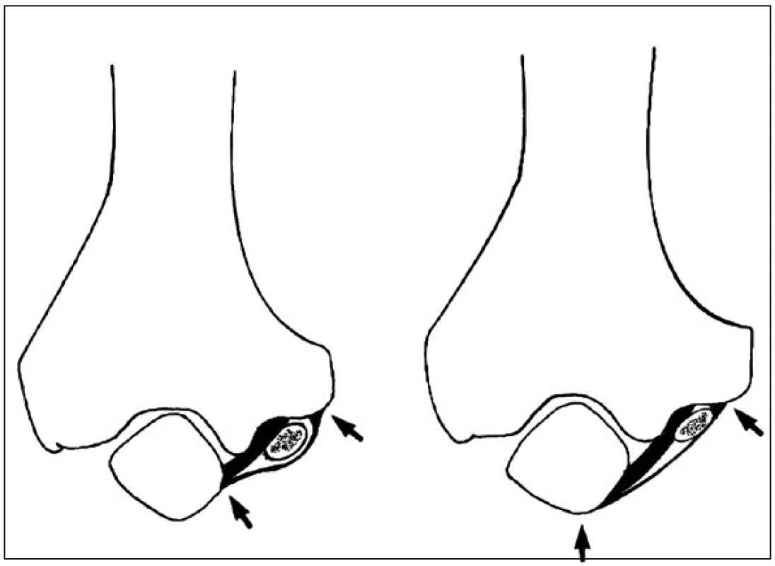 N. ulnaris v lokti při extenzi (A) a jeho komprese při flexi v lokti (B).
Fig 3. The ulnar nerve at the elbow during extension (A) and its compression during the flexion in the elbow (B).