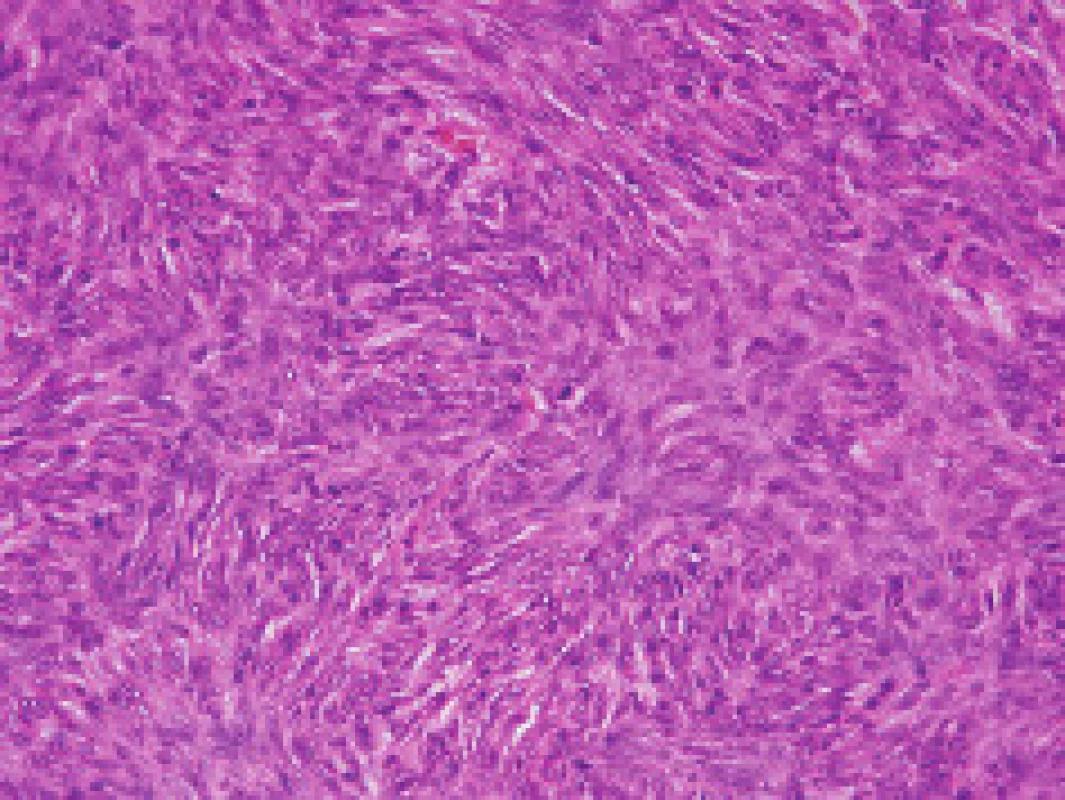 Solitární fibrózní tumor, nepravidelná vřetenobuněčná nádorová infiltrace s vmezeřenými snopci kolagenních vláken, přehledné barvení hematoxylin- eozin, 200×.