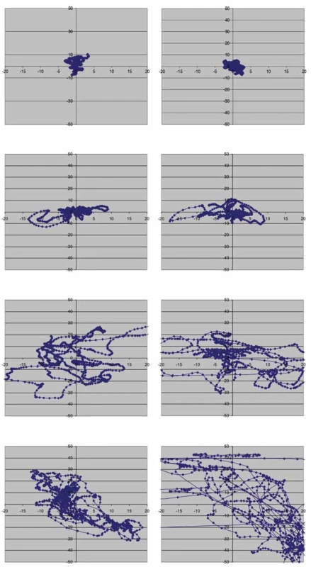Grafické znázornění instability u jednotlivých typů ataxie.
Na obrázku je modře znázorněna dráha středu tlakového zatížení plosek (Centre of Pressure; COP). Ve stoji přímém si lze střed tlakového zatížení představit jako průmět těžiště těla na podložku a grafické znázornění jeho dráhy proto poskytuje představu o posturální stabilitě. Jsou zobrazeny různé typy ataxií. U cerebelární ataxie je patrna porucha posturální stability, která není v tomto případě výrazná a závažněji se po odebrání zrakové kontroly nemění. U ataxie senzitivní je také patrna porucha stability, která se však významně zhorší po odebrání zrakové kontroly. Pacient s čerstvou vestibulární ataxií (cca 3 dny od vzniku akutního periferního vestibulárního syndromu) nemá kupodivu poruchu stability v přímém stoji lateralizovanou, jak by bylo možné očekávat, ale na rozdíl od předchozích typů ataxií neustále mění zatížení plosek ze strany na stranu. Frekvence těchto změn se ještě zvýší po odebrání zrakové kontroly. Nejspíše se jedná o kompenzační mechanizmy k zajištění stability.
Fig. 1. Graphical depiction of instability in different types of ataxia.
The center of foot pressure (COP) trajectory is shown in blue. The COP during stance can be imagined as a projection of the center of gravity of the body on the surface, so the graphical
representation of its trajectory provides information about postural stability. Different types of ataxia are graphically represented. In cerebellar ataxia, postural instability is evident, but not significant and does not fundamentally change after removal of the visual control. Sensory ataxia is also characterized by postural instability, but it is significantly worse after removal of the visual control. A patient with acute vestibular ataxia (approx. 3 days after the onset of acute peripheral vestibular syndrome) surprisingly does not show laterality of postural imbalance but compared to previously mentioned types of ataxia constantly moves the center of pressure from side to side. The frequency of these changes increases after removal of visual control. These are probably postural compensatory mechanisms.