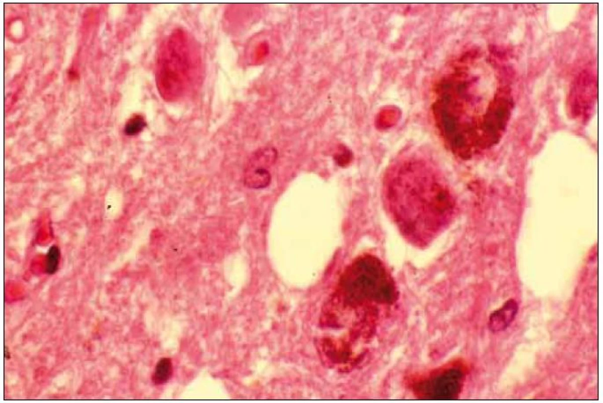 Pigmentované a depigmentované neurony v substantia nigra.
Barvení hematoxilin eozin.