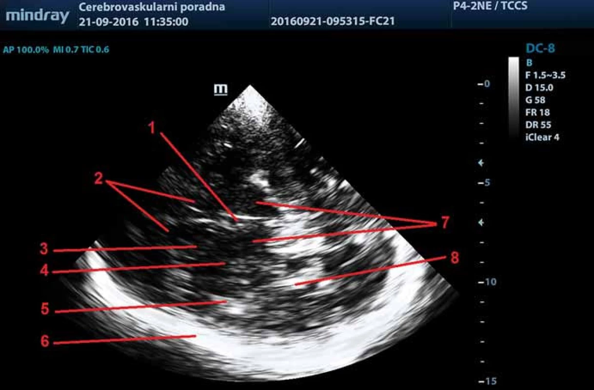 Zobrazení intrakraniálních struktur v ultrazvukovém B obraze – transverzální thalamický řez.
1 – 3. komora, 2 – frontální rohy postranních komor, 3 – caput ncl. caudati, 4 – ncl. lentiformis, 5 – inzula, 6 – kontralaterální kortex a subarachnoidální prostory, 7 – thalamy, 8 – plexus choroideus v okcipitálním rohu postranní komory.
Fig. 1. Sonographic B-Mode imaging of intracranial structures – transverse thalamic plane.
1 – third ventricle, 2 – frontal horns of lateral ventricles, 3 – head of caudate nucleus, 4 – lentiform nucleus, 5 – insula, 6 – contralateral cortex and subarachnoid space, 7 – thalamus, 8 – choroid plexus in the occipital horn of lateral ventricle.