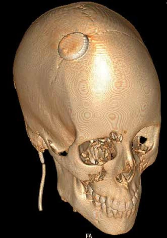 3D rekonstrukce z CT mozku po implantaci telemetrického čidla u pacientky 3.
V tomto případě jsme nevolili trepanaci v Kocherově bodě, ale v místě potenciálně indikované endoskopické ventrikulostomie třetí komory. Při ventrikulostomii bylo čidlo dočasně extrahováno a po dokončení zákroku bylo opět vráceno do původní pozice, kde bylo ponecháno po dobu tří dnů.