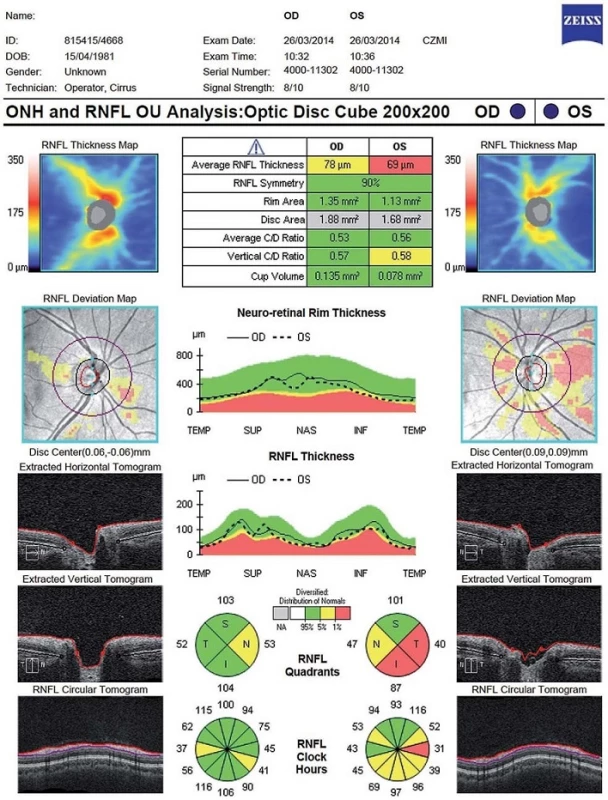 Vyšetření vrstvy nervových vláken (Retinal Nerve Fibre Layer; RNFL) a terče zrakového nervu (optic nerve head) – patologický nález (Cirrus OCT HD), na levém oku stav po optické neuritidě.