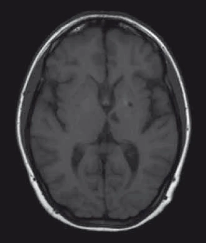 MR mozku, axiální řez, T1 vážený obraz, 28letá pacientka s Fabryho chorobou, lakunární infarkty v hlubokých strukturách.
Fig. 1. Brain MRI, axial plane, T1-weighted image, 28-year-old female patient with Fabry disease, lacunar infarctions in deep brain structures.