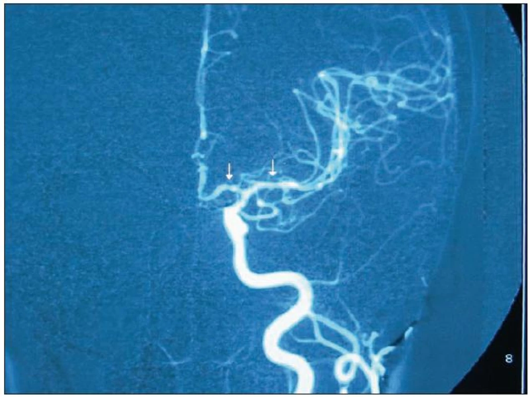 DSA obraz vícečetných segmentálních stenóz (vazospazmů) na pravé středních mozkové tepně u pacientky s RCVS.