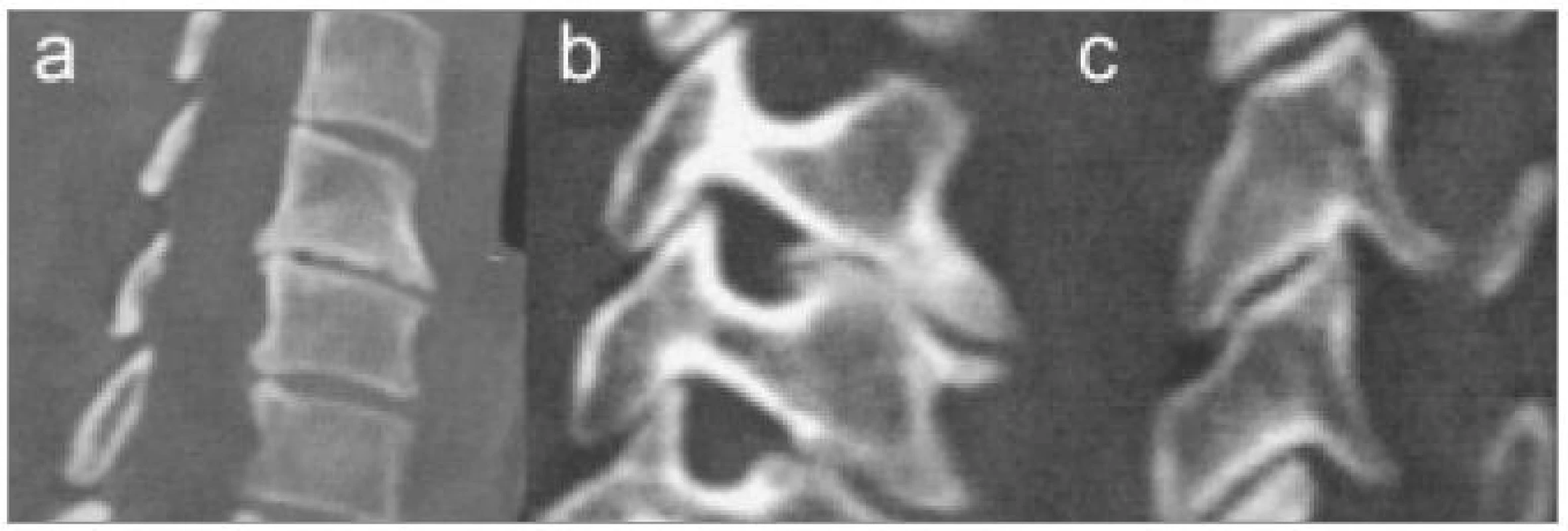 CT rekonstrukce v sagitální a parasagitálních rovinách zobrazující různé typy degenerativních změn.
a) Osteofyty v prostoru C5/6 i C6/7.
b) Unkovertebrální neoartróza zužující foramen intervertebrale C5/6.
c) Počínající artróza meziobratlového kloubu.