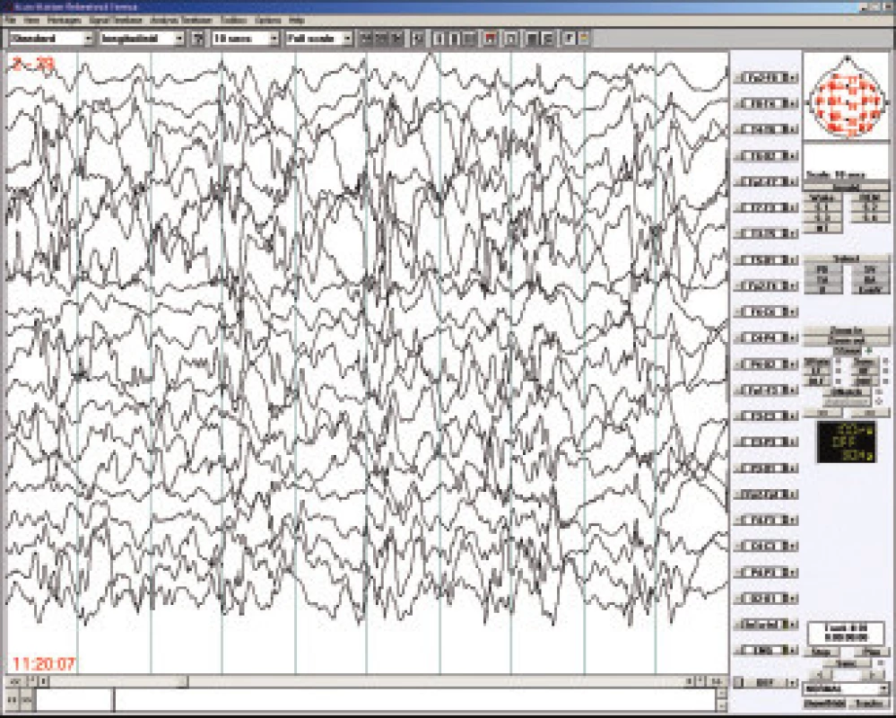 Westův syndom – hypsarytmie, bdělé EEG u 5měsíčního dítěte.