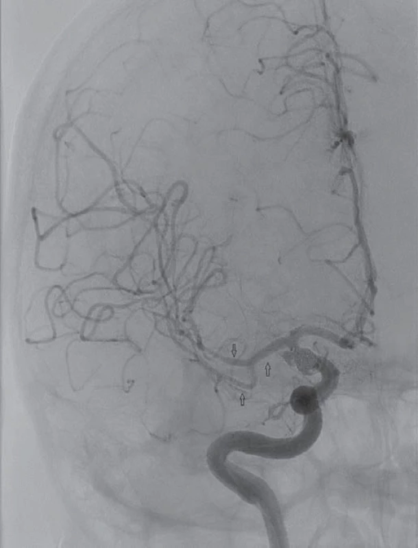 Digitální subtrakční angiografie po infuzi 9 mg mil rinonu selektivně do střední mozkové arterie vpravo. Patrná regrese cerebrálních vazospazmů na M1,M2 a M3 úseku s kompletní úpravou levostranné hemiplegie.