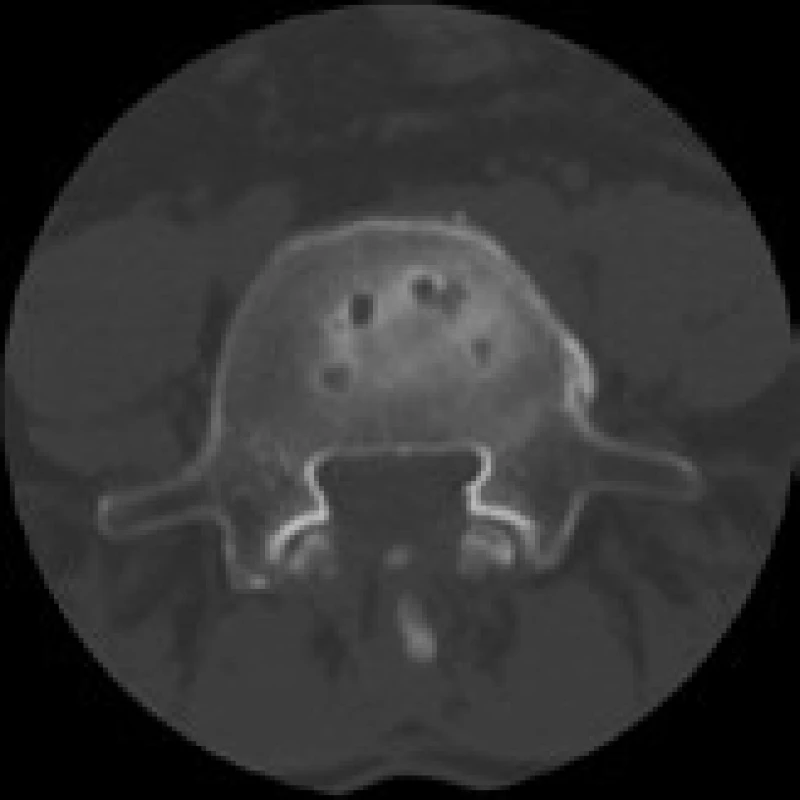 CT snímek 12 měsíců po operaci ALIF stand-alone (Visios) v L4/5 pro FBSS u stejného pacienta. Vyšetření prokazuje cystické kostní změny cirkulárně na styčné ploše obratlového těla L5 a implantátu. Axiální sken.
