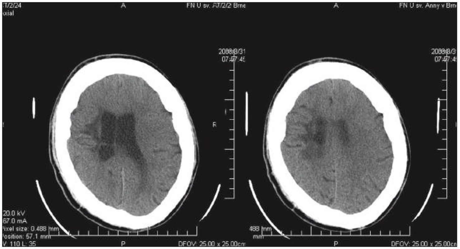 Hypodenzní změny v CT obraze postihující bílou hmotu ve fronto-parietální oblasti – stav po infekční komplikaci po provedené hypotermii mozku.

