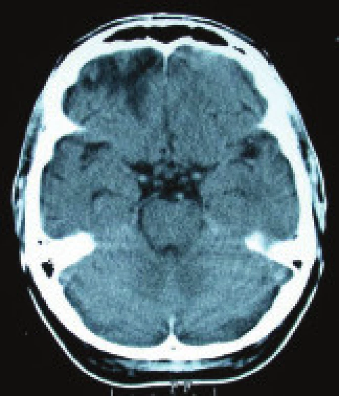 Kazuistika 2: CT mozku, měkkotkáňové okno, axiální řezy, na snímku je patrné hypodenzní ložisko frontobazálně vpravo.