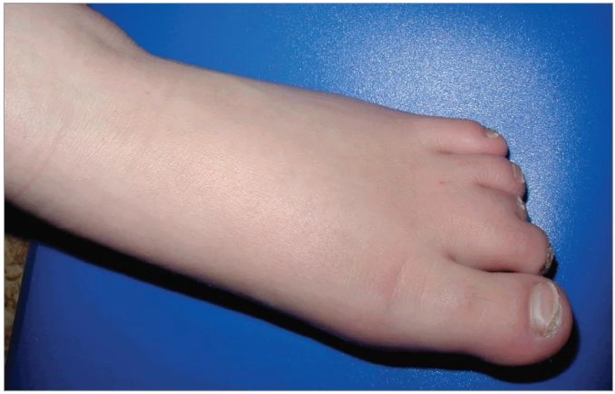 Brachydaktylie na dolních končetinách. Dále je patrná syndaktylie 2. a 3. prstu, která je vedlejším nálezem a není pro tento syndrom typická.