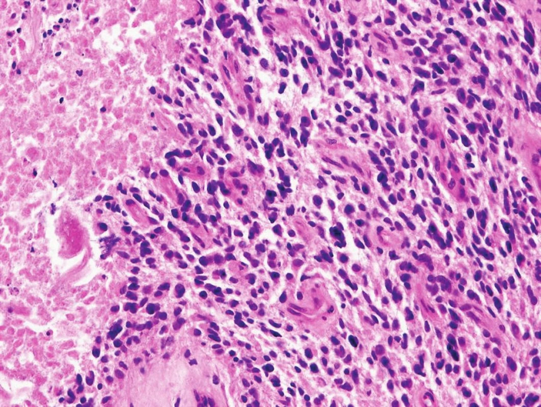 Na histologickém preparátu je patrná zřetelná polymorfie nádorových buněk, zvýšená vaskularizace tumoru a ložisko nekrózy na jejím okraji s naznačeným palisádovým uspořádáním nádorových buněk multiformního glioblastomu. (barvení HE, zvětšení 200×).