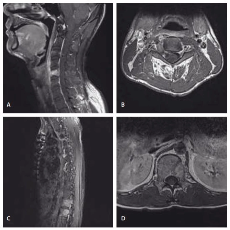Preoperative MRI. T1-weighted images with contrast showing a homogenous enhancing mass lesion in the C5 vertebral body (A), and a dumbbell-shaped mass lesion in the right foramen at the C3–C4 level (B). It also showed a homogeneous enhancing mass lesion in the T12 vertebral body invading the epidural space (C) and the L1 vertebral body and left pedicle (D).