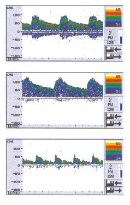 Ultrasonografické průtokové křivky v a. cerebri media a/ v klidu, b/ při zadržení dechu (BH) na 30 sek a c/ při hyperventilaci po dobu 2 minut.