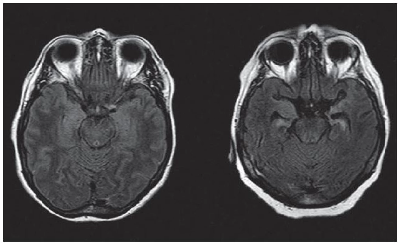 Různá intenzita změn meziotemporálně na MR mozku (axiální FLAIR) u pacientek s pozitivitou anti-LGI1 a klinickými projevy limbické encefalitidy – vlevo S. M., vpravo M. A.