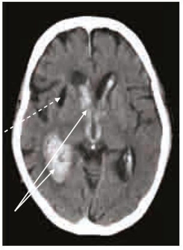 Masivní intraventrikulární krvácení (šipky) u warfarinizovaného pacienta (INR 4,3). Starší posthemoragická pseudocysta (přerušovaná šipka). CT vyšetření 40 min po příhodě.
