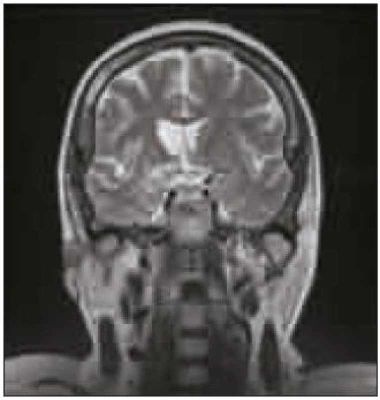 Na MR mozku v T2 zobrazení je patrna v levostranných bazálních gangliích pravidelná konfigurace a intenzita
signálu, vpravo je pouze naznačena drobná část putamen, další ganglia nejsou již diferencovatelná. Dále je
patrné rozšíření frontálního rohu pravé postranní komory a atrofie pravého frontálního laloku.