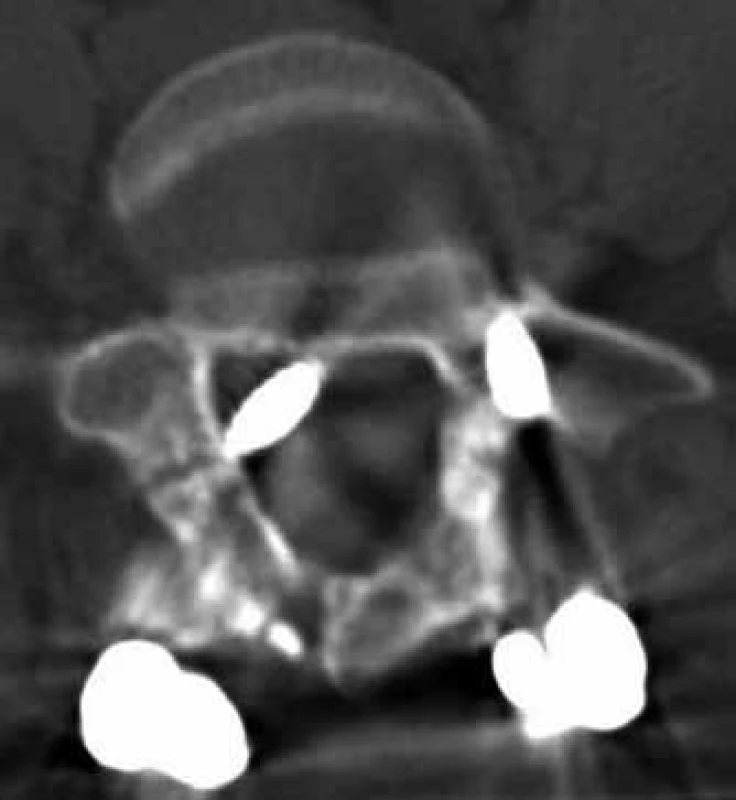 Zavedení pedikulárního šroubu do kanálu páteřního (transverzální CT řez).