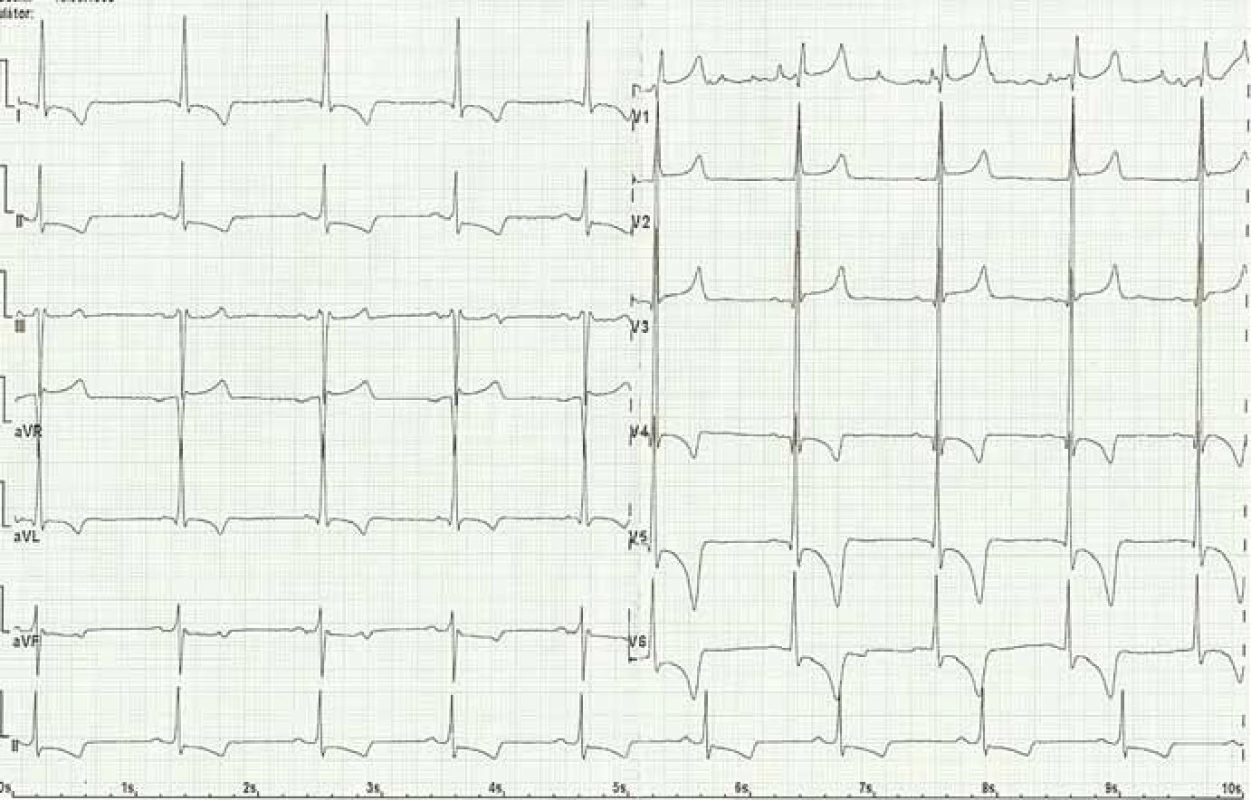 Elektrokardiogram pacienta s Fabryho chorobou: sinusový rytmus, pravidelný, bradykardie 55/min, PQ 170 ms, QRS 100 ms, QT 415 ms, známky hypertrofie levé komory s jejím zatížením (Sokolow, Lyon index, inverze T vlny a deprese ST úseku).
Fig. 5. Electrocardiogram of Fabry disease patient: sinus rhythm, regular, bradycardia 55/min, left ventricular hypertrophy, PQ 170 ms, QRS 100 ms, QT 415 ms, signs of the left ventricula hypertrophy with its load (Sokolow, Lyon index, inverted T wave and ST depression).