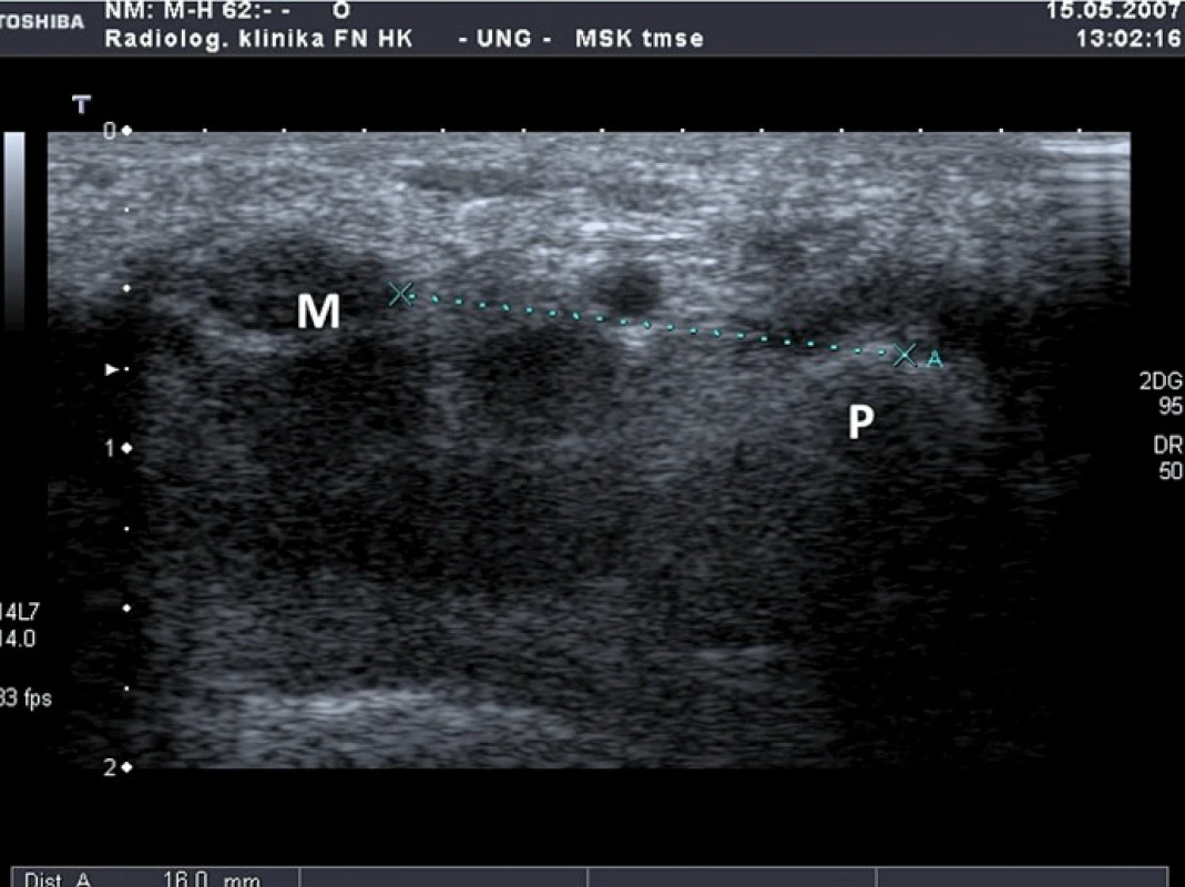 Příčný řez zápěstím v úrovni os pisiforme (M – nervus medianus, P – os pisiforme).