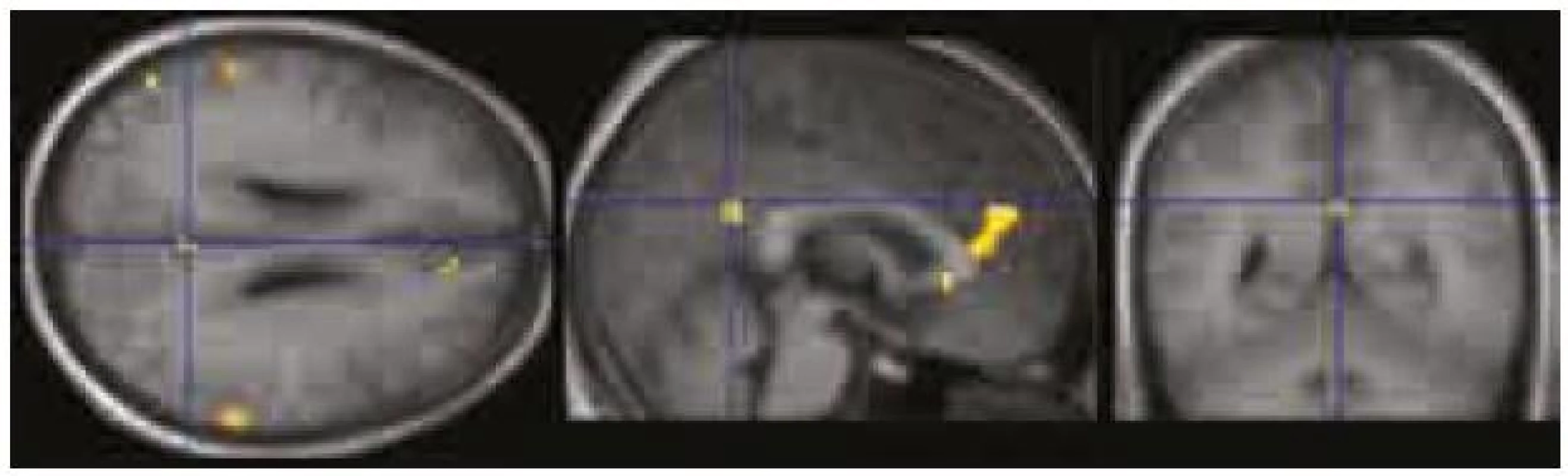Oblasti deaktivující se v průběhu vizuálního kognitivního úkolu se nacházejí v pravém precuneu/zadním cingulu, pravém ventromediálním prefrontálním kortexu a v lobulus parietalis inferior bilaterálně.
Jde o sníženou aktivitu (deaktivaci) v DMS oproti jejímu základnímu stavu, který představuje resting state. Zobrazeno při p &lt; 0,0001 nekorigovaně.