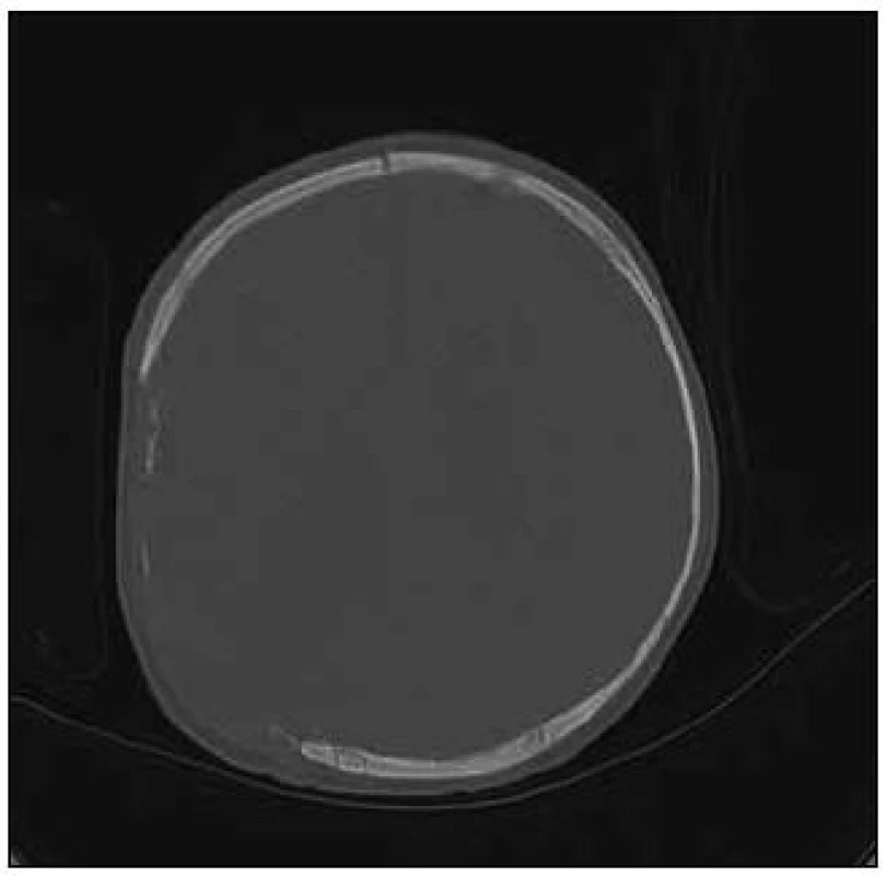 CT vyšetření (kostní okno) po dekompresní kraniektomii a odsátí kontuzně změněné mozkové tkáně.