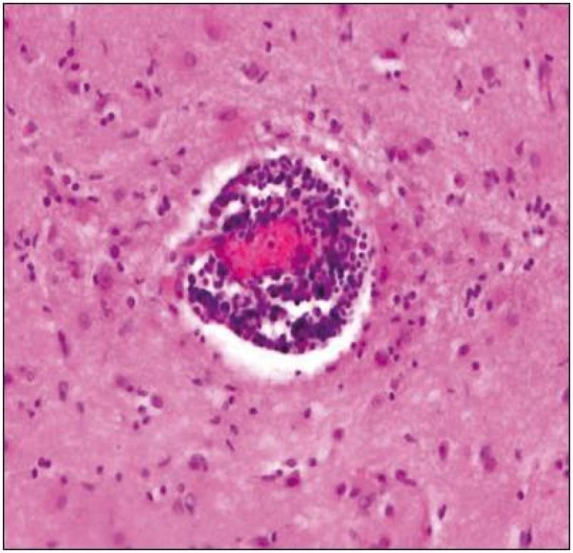 Bílá hmota temporálního laloku mozku v centru s plášťovým perivenulárním mononukleárním infiltrátem a v okolí s počínající demyelinizací. V bílé hmotě jsou patrné drobné zánětlivé infiltráty a proliferace astroglie.
