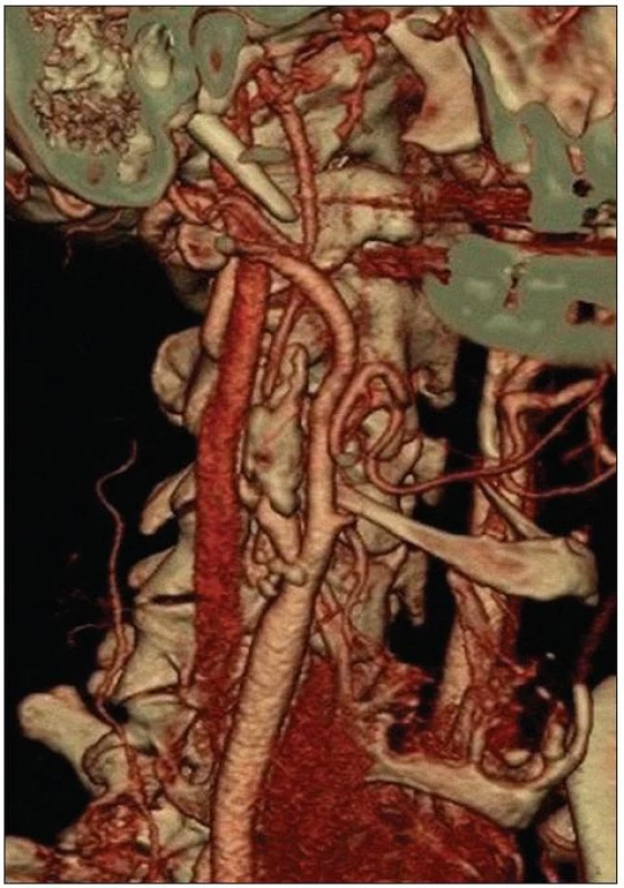 CT angiografie zobrazuje kritickou stenózu vnitřní krkavice na podkladě masivního nerovného plátu s chabým plněním tepny nad stenózou.