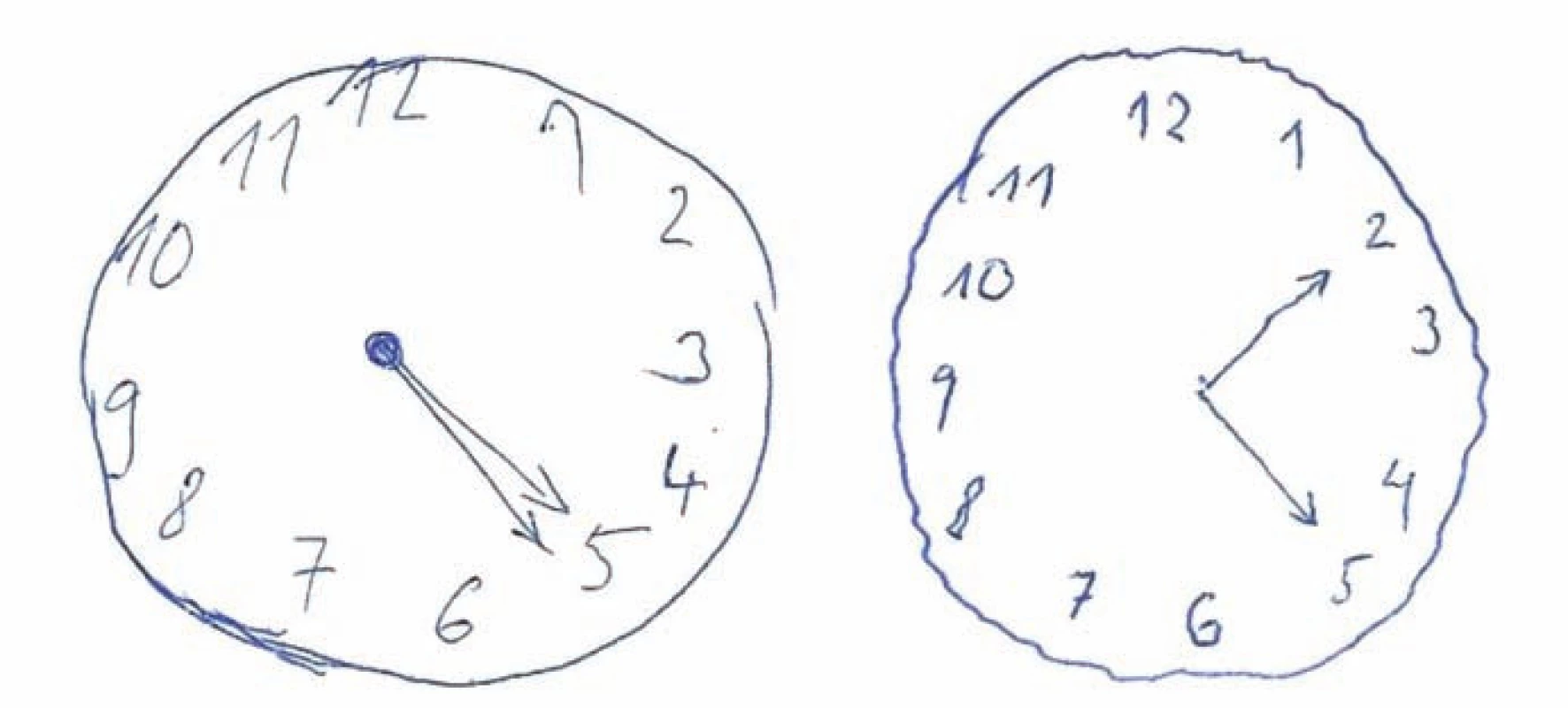Ciferníky s různě závažnou odchylkou od správného řešení hodnocené škálou Addenbrookského kognitivního testu (ACE).
Závažnější chyba je skórovacím systémem ACE hodnocena stejným počtem bodů jako chyba méně závažná. Oba ciferníky s požadavkem času 5 hod 10 min získají v ACE 4 body. V prvním ciferníku jsou zakresleny stejně dlouhé ručičky ukazující špatný čas, což považujeme za závažnou chybu. Druhý obsahuje pouze shodně dlouhé ručičky při správném nastavení.
Fig. 1. Dials with different abnormalities compared to the correct performance rated using Addenbrooke´s Cognitive Examination (ACE) rules.
A major mistake is rated as a minor one by the same number of points using a scoring system of ACE. Both dials with a time of 5 hours 10 minutes will be scored with 4 points according to ACE instructions. The first dial contains equally long hands showing the wrong time. We consider it as the major mistake. The second one contains only equally long hands which are placed correctly.