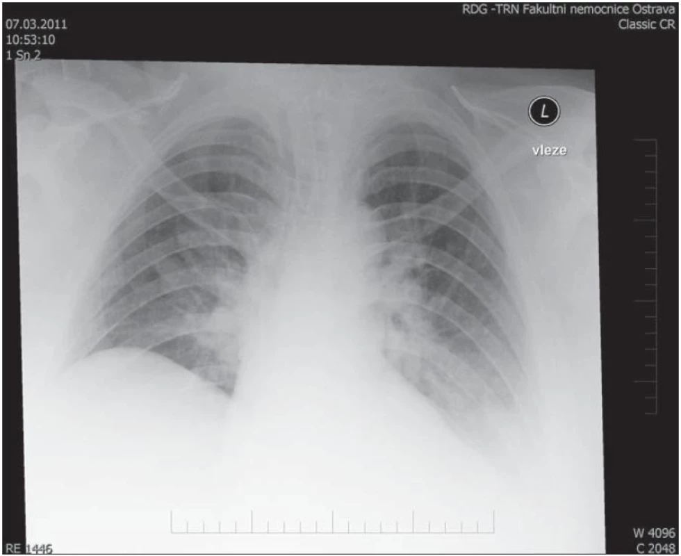 Rentgen plic: oboustranná bronchopneumonie.