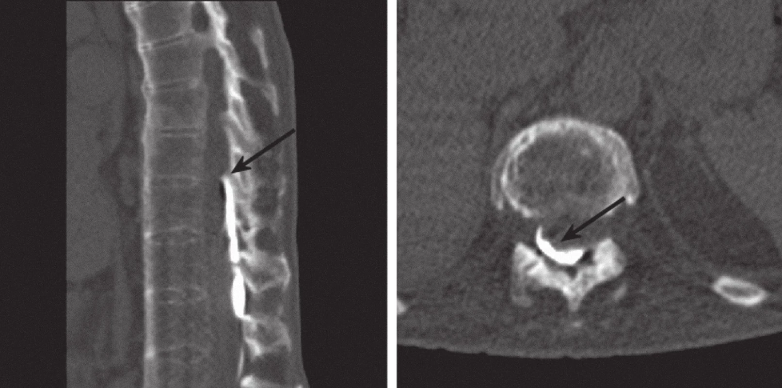 Myelo- CT: nativní CT po aplikaci 4 ml Iomeronu bočním portem do baklofenové pumpy. Katétr probíhá v epidurálním prostoru, hrot je při horním okraji Th 11, kontrastní látka je patrna dorzálně v epidurálním prostoru (označené šipkami). Sagitální řez po CT rekonstrukci (vlevo) a příčný řez (vpravo).