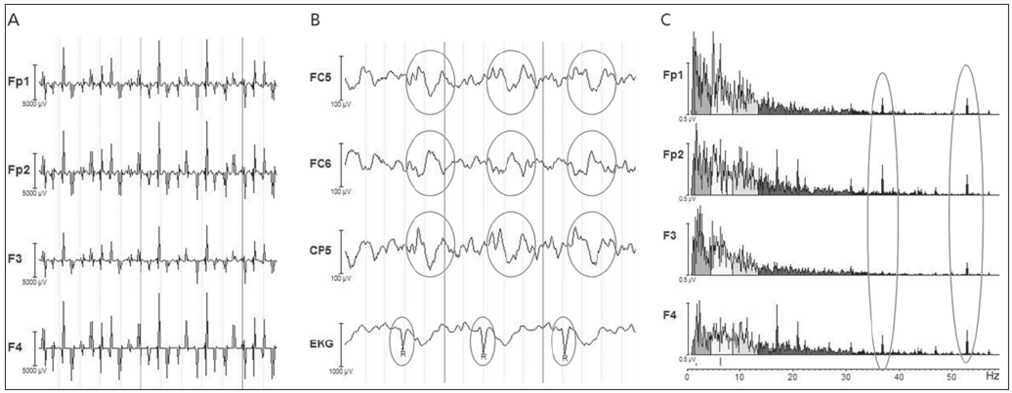 Artefakty v EEG signálu.
a) gradientní artefakt, b) pulzní artefakt, c) artefakt způsobený pumpou chladicí kapaliny ve formě špiček ve spektru EEG signálu, typicky kolem 40 Hz.