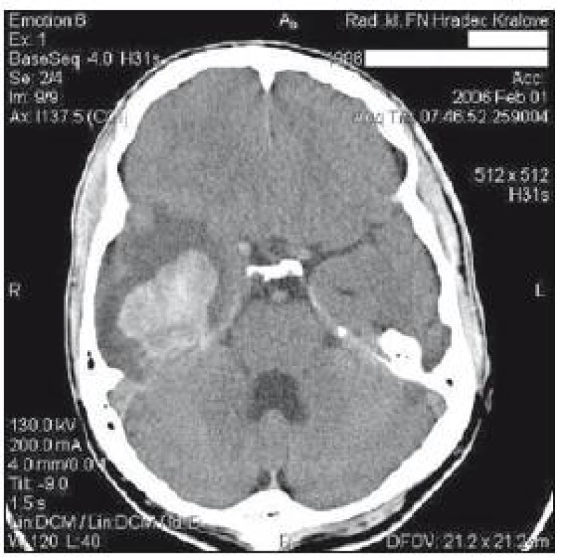 CT mozku z 1. února: hematom temporobazálně o průměru cca 7 cm, prosakování krve subependymálně do trigona pravé postranní komory a subarachnoideálně vpravo.
