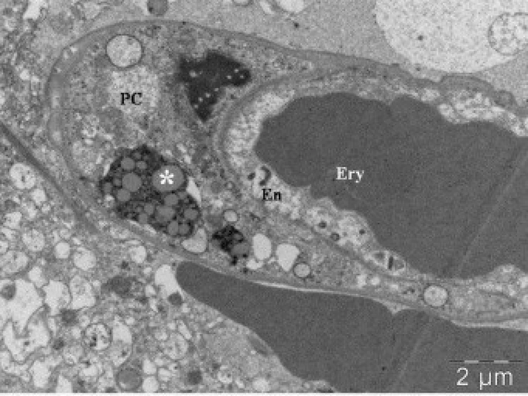 Elektronová mikroskopie kontuzního ložiska u pacienta (soubor I), zobrazení lumen kapiláry s erytrocytem (Ery). Na řezu zachycena endotelie (En) a pericyt (PC) s telolyzozomem (*).