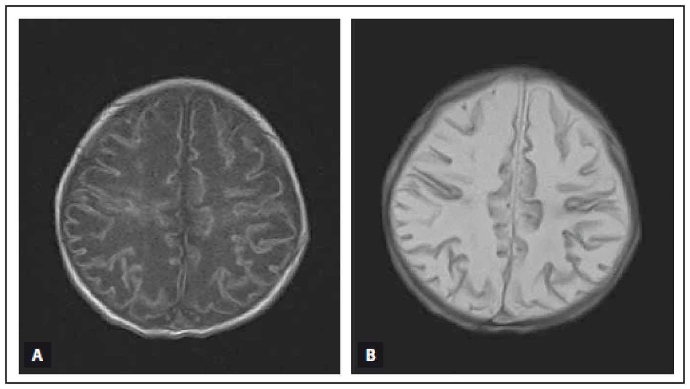 MR vyšetření mozku donošeného novorozence (dívka, gestační věk 40 + 0), kortikální a subkortikální změny s ischemickým postižením bílé hmoty mozkové při těžké HIE.
Fig. 5. MRI of a term-neonatal brain (girl, gestational age 40 + 0), cortical and subcortical lesions with ischaemic changes of the white matter in frontal and parietal lobes in severe HIE.
