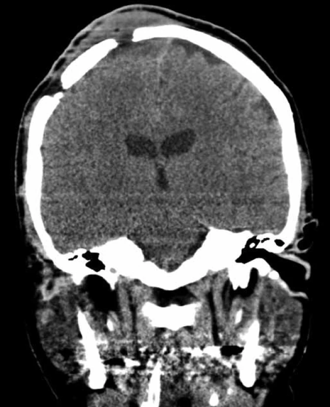Počítačová tomografie provedená osm měsíců po operaci ukazuje tumorózní hmoty v mozkových plenách propagující se otvorem kraniotomie do měkkých pokrývek lebečních. Intradurálně bez známek recidivy tumoru.
