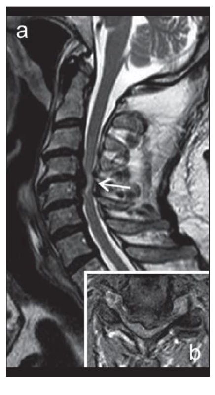 MR zobrazení krční páteře v T2 obraze v sagitální (a) a axiální (b) rovině u pacienta s klinickými známkami myelopatie.